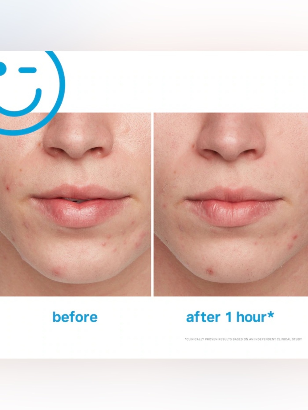 NEW Kate Somerville EradiKate Acne Treatment 10% Sulfur Spot Treatment - Picture 4 of 6